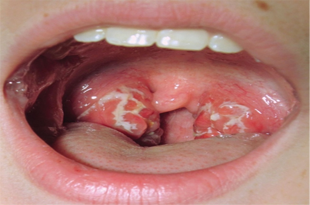 Tonsil Cancer: यह लक्षण देख टॉन्सिल्स से बच सकते है केंसर होने से
